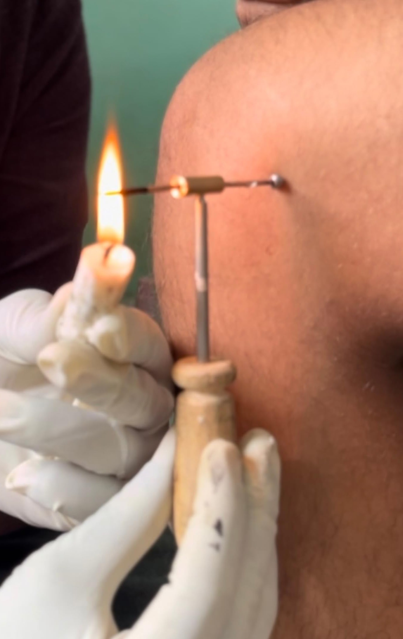 Agnikarma Treatment